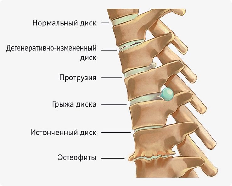 Дефекты позвоночника человека