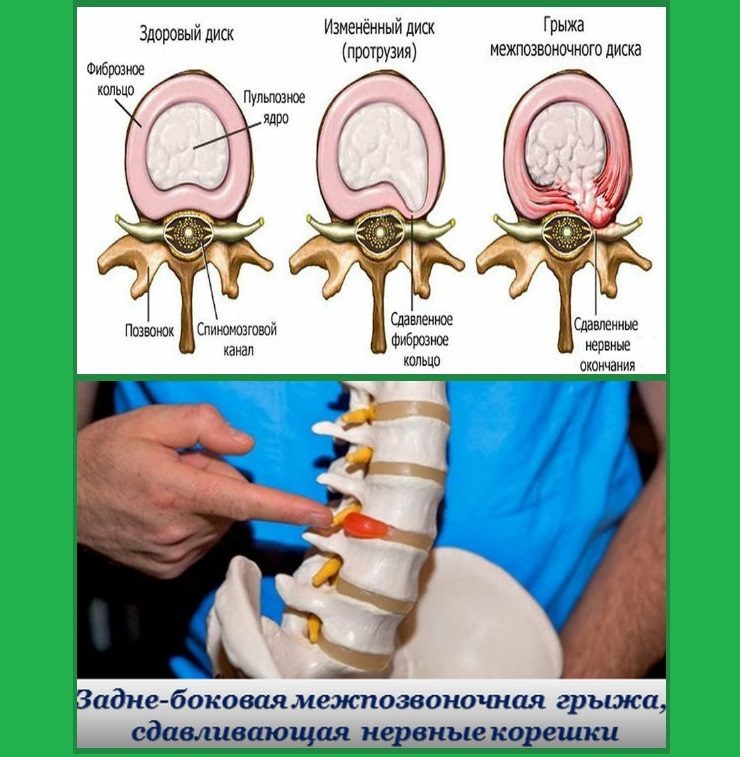 Протрузия и грыжа межпозвоночного диска