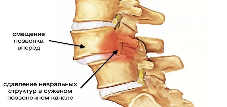 Дефекты позвоночника