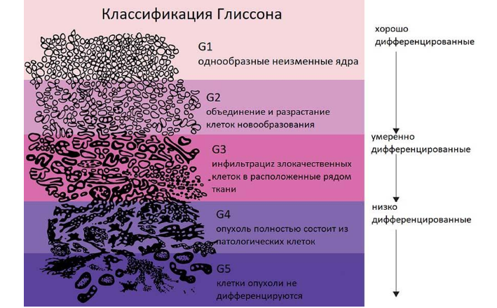 Аденокарцинома предстательной железы у мужчин по глисону: классификация