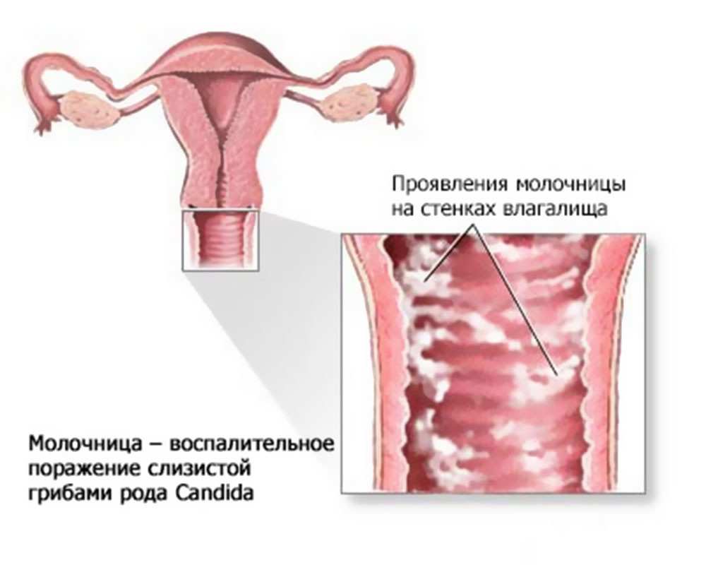 Схема заражения молочницей
