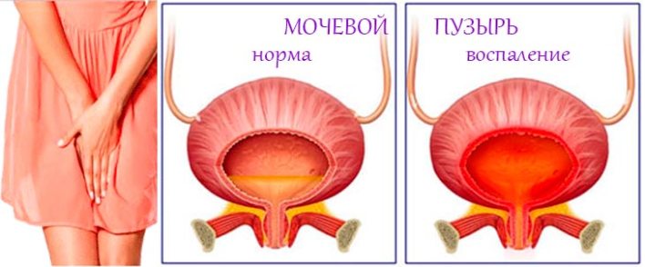 Недержание мочи у женщин при заболеваниях мочевого пузыря