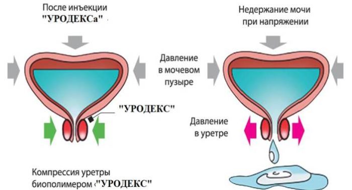 Недержание мочи у женщин: лечение