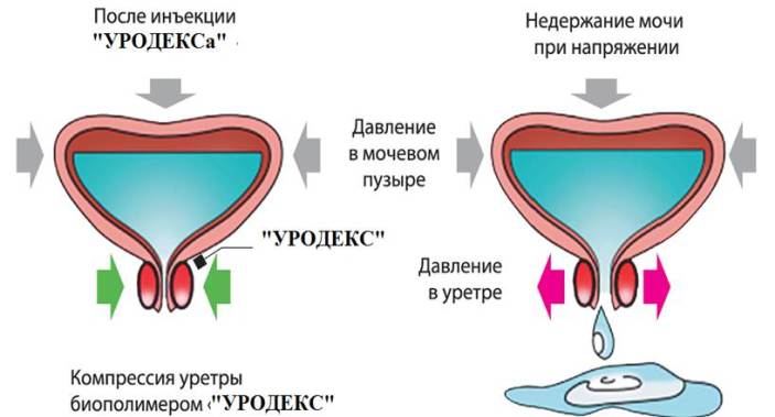 Недержание мочи у женщин: лечение