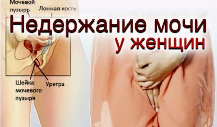 Недержание мочи у женщин