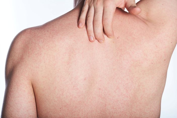 Прыщики, сыпь, красные бугорки на спине