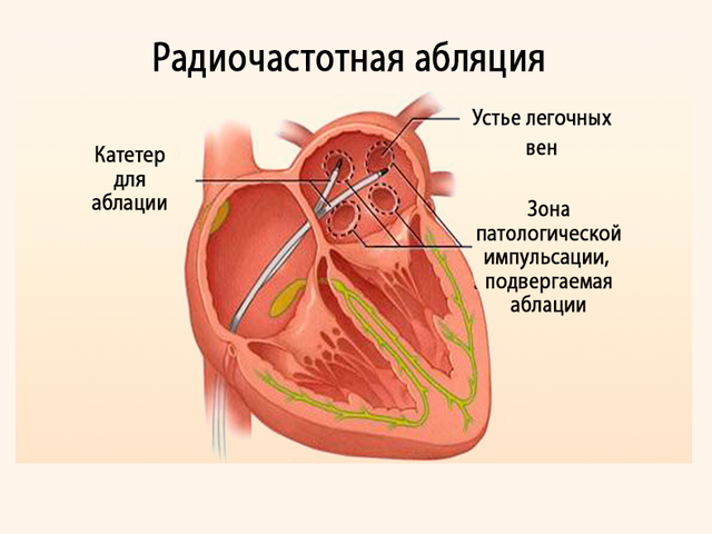 Прижигание сердца при мерцательной аритмии и тахикардии: стоимость операции, последствия, отзывы — как делают?