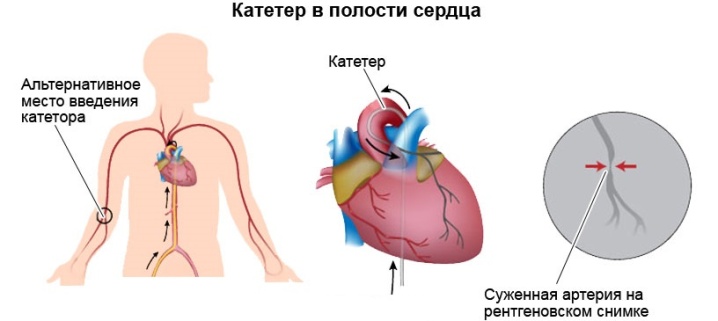 Прижигание сердца