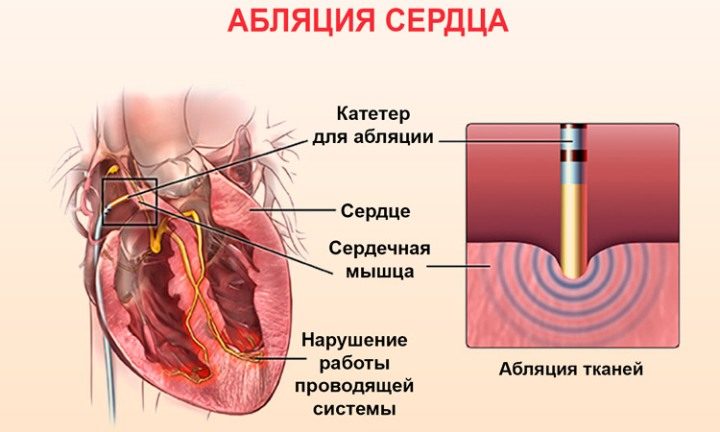 Прижигание сердца