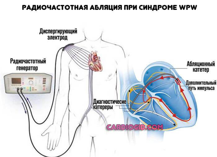 Прижигание сердца