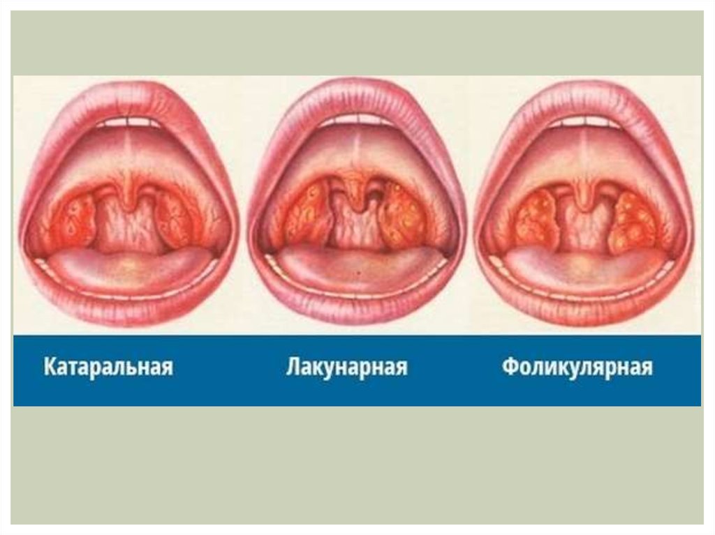 Виды ангины