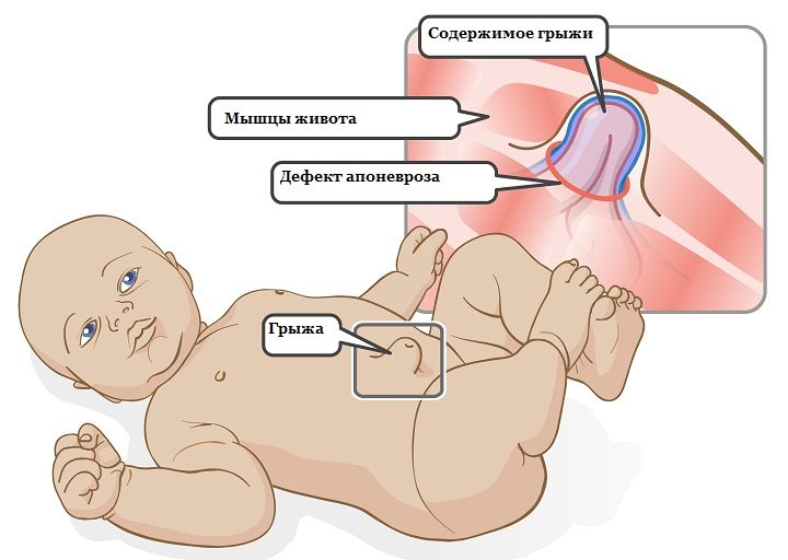 Понятие грыжи