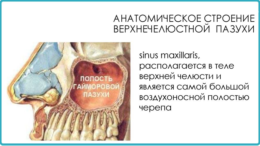Гайморова пазуха или синус