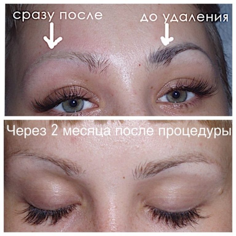 Удаление