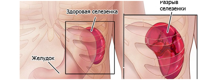 Разрыв селезенки