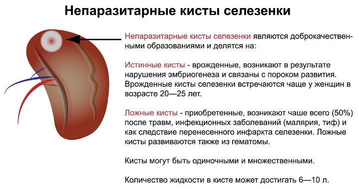 Киста селезенки