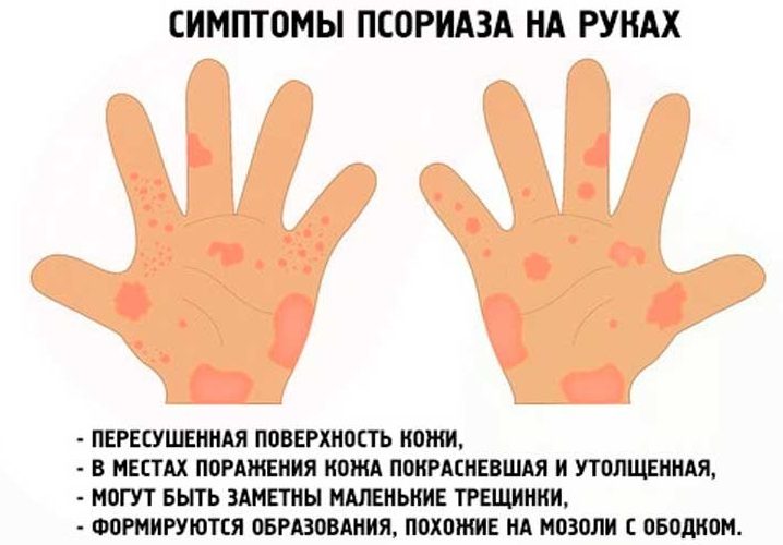 Псориаз на руках