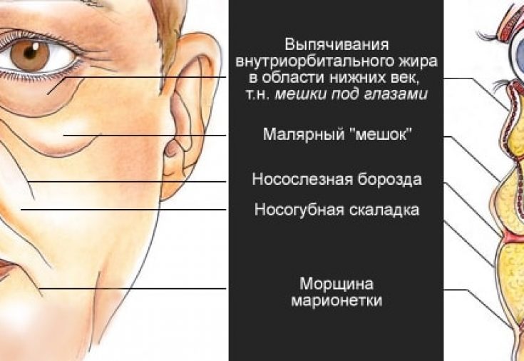 Выпячивание