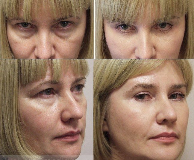 Улучшение