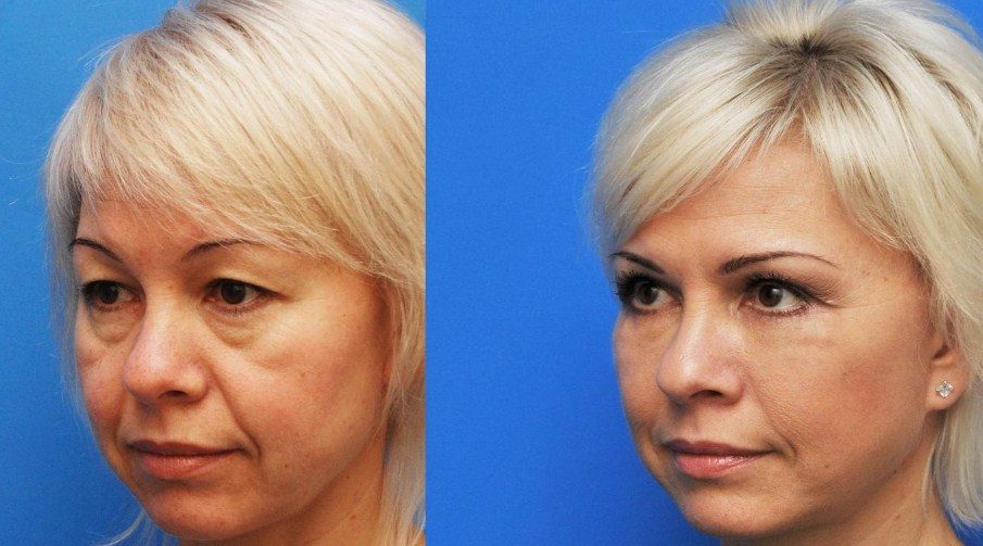 Лицо молодеет на десяток лет