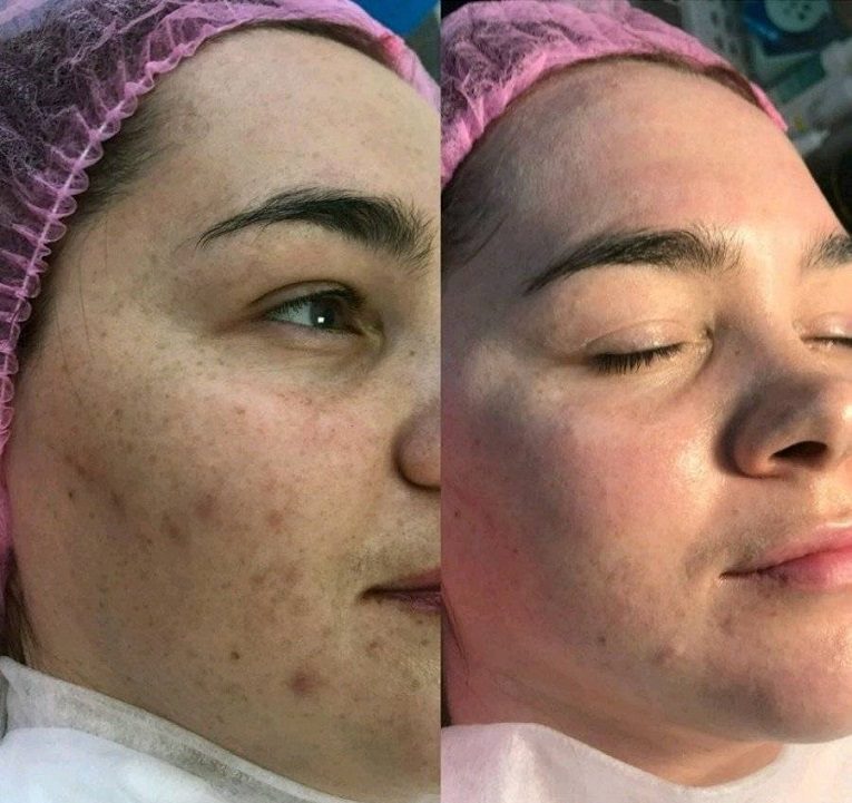 Крем bb glow от пигментации