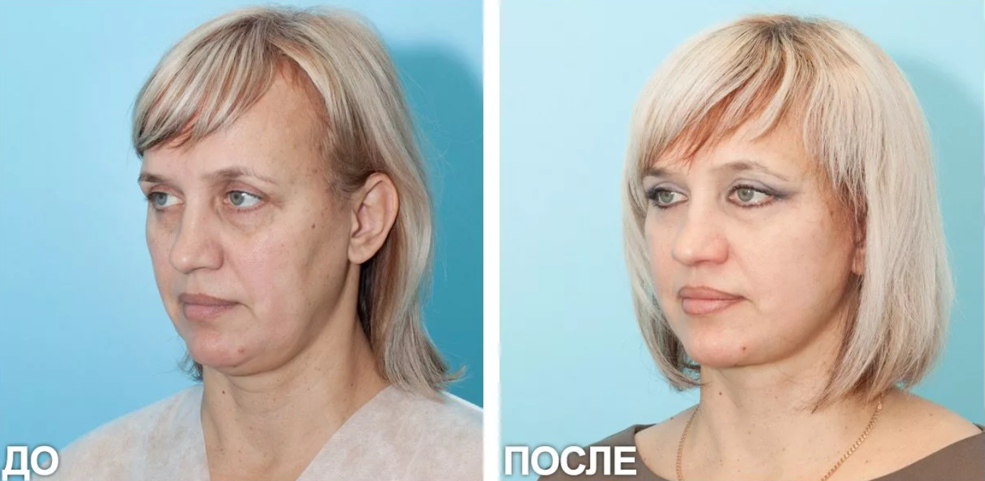 До и после 3