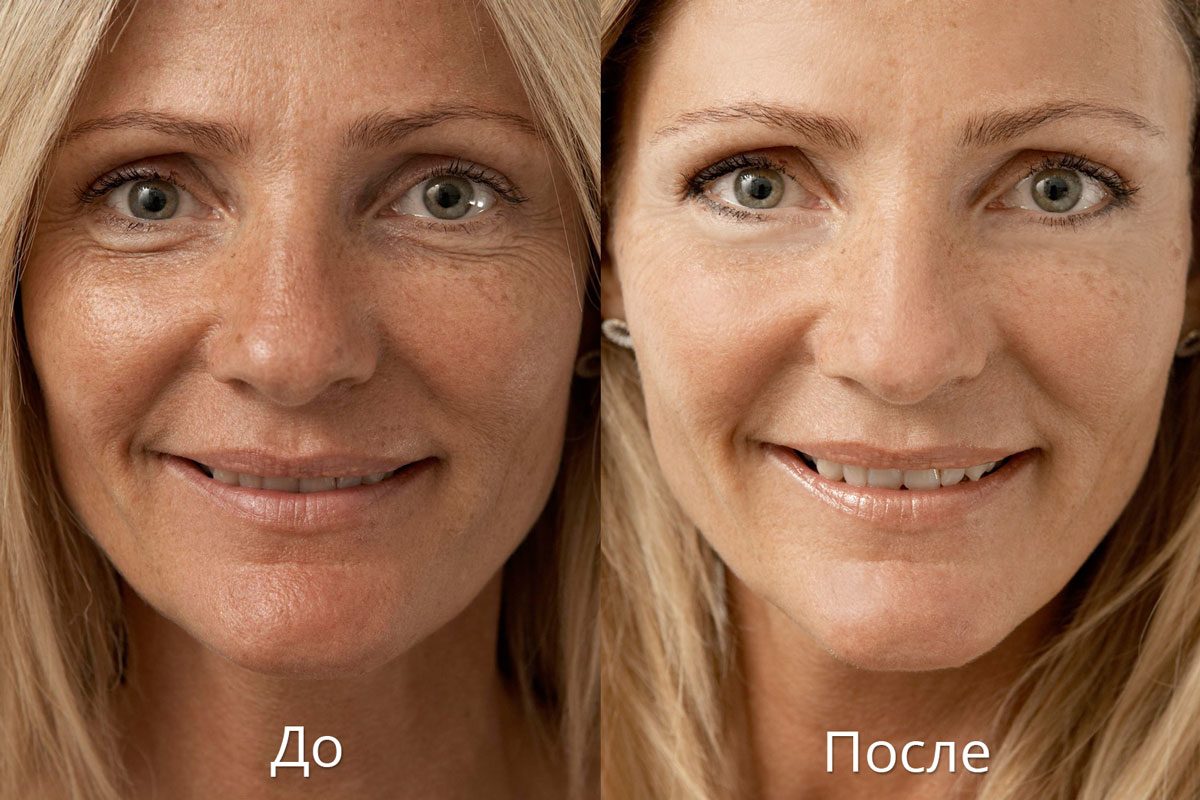 Результат омоложения