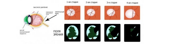 Глаукома глаза