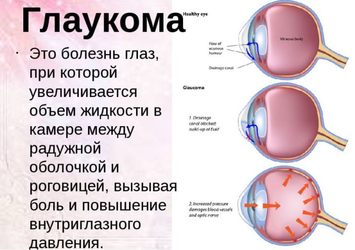 Лечение глаукомы