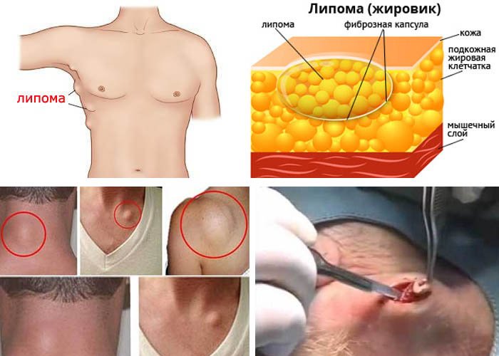 Липома