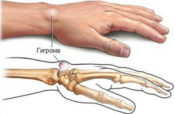 Гигрома