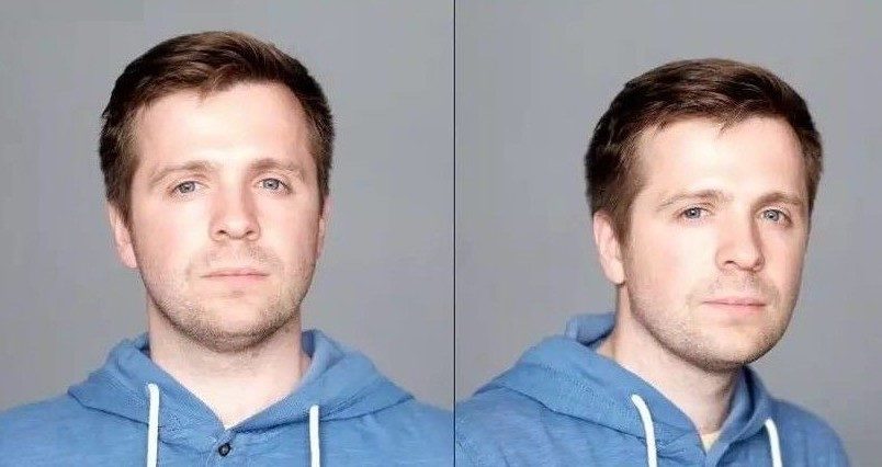 Двойной подбородок