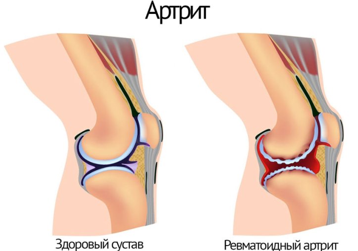 Артрит коленного сустава