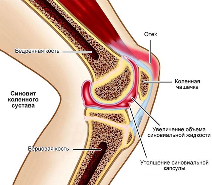 Синовит коленного сустава