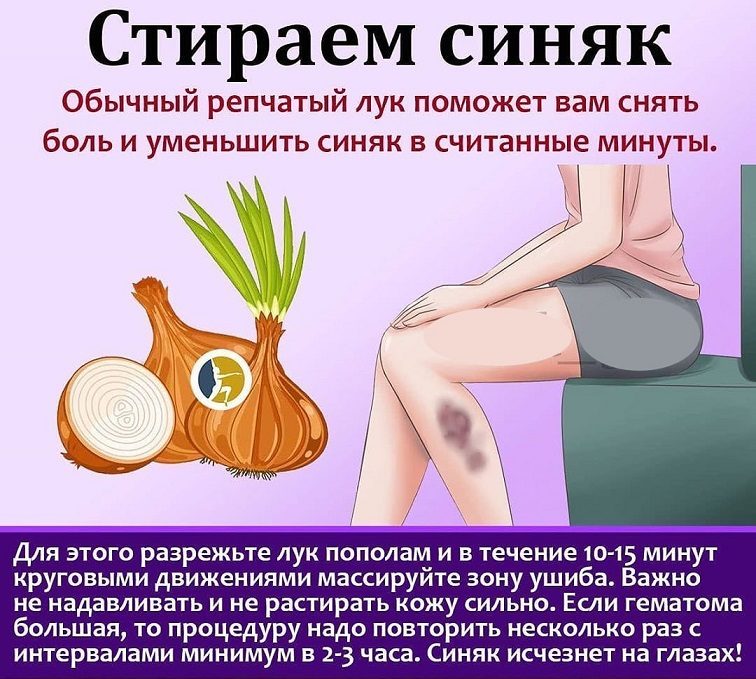 Репчатый лук от синяков