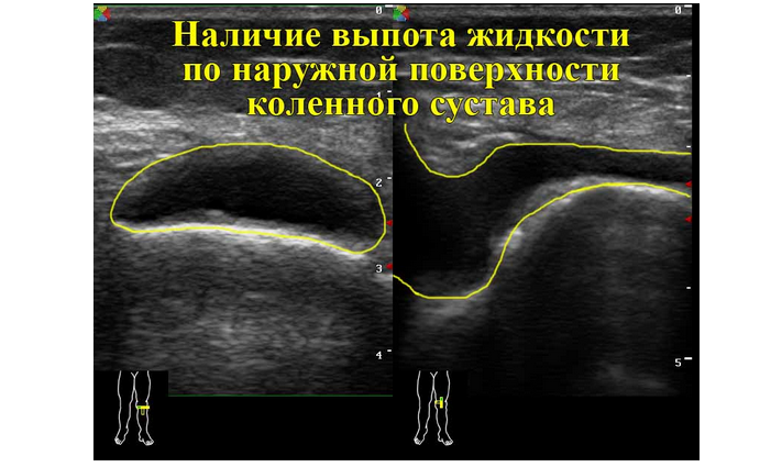 Узи коленного сустава