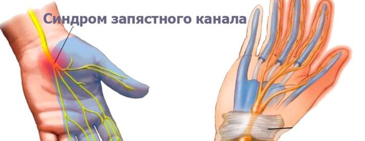 Тоннельный синдром правого запястного (карпального) канала кисти руки