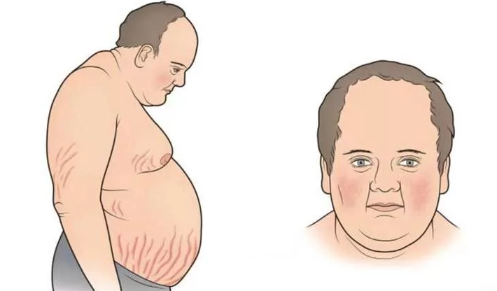 Синдром кушинга — пнс