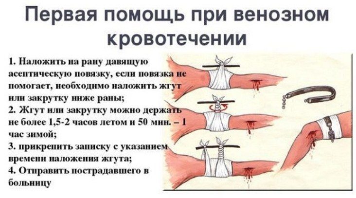 Жгут наносится при сильном кровотечении
