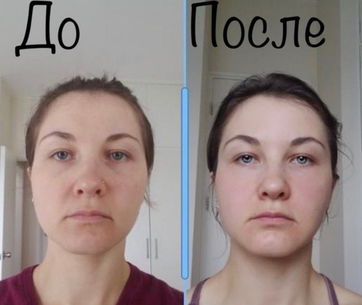 Тейпирование лица, результаты до и после