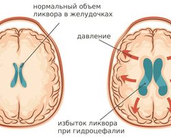 Как снизить внутричерепное давление — что это такое, как лечить: таблетки, народные средства, продукты