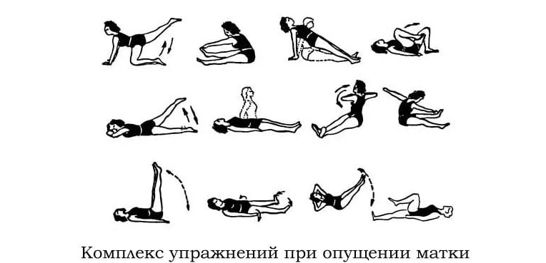 Упражнения при выпадении и опущении матки
