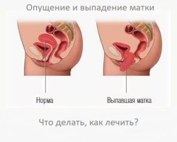 Опущение и выпадение матки: причины, симптомы, стадии, лечение