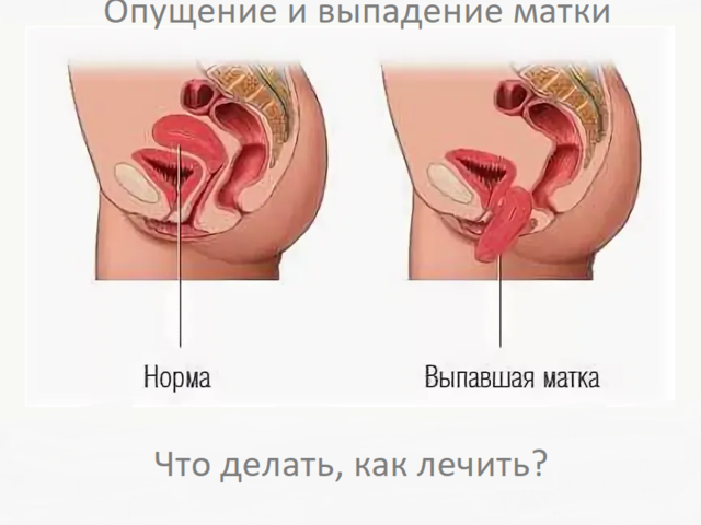 Опущение и выпадение матки: причины, симптомы, стадии, лечение
