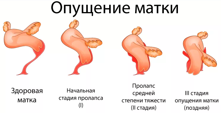 Опущение матки