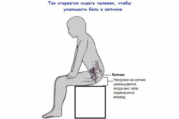 Боли, отдающие в копчик