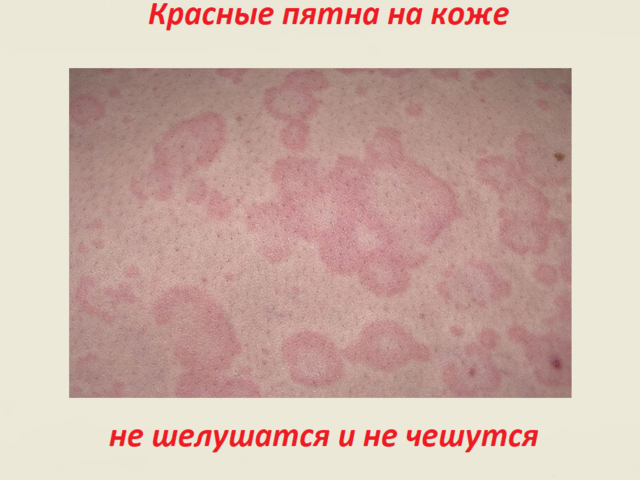 Красные пятна на коже не чешутся и не шелушатся: что это может быть?