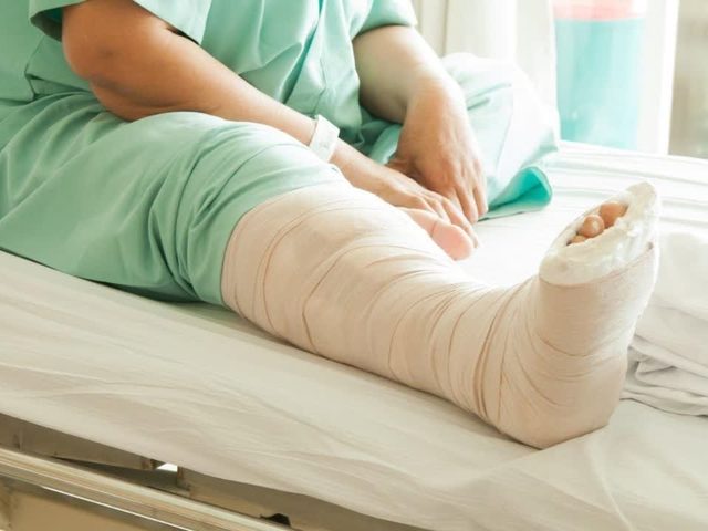 Как долго заживает перелом, срастаются кости: открытый, закрытый, со смещением, без него. Процесс восстановления, правильное питание: срастание костей без гипса