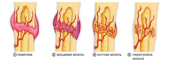 Стадии заживления перелома костной ткани