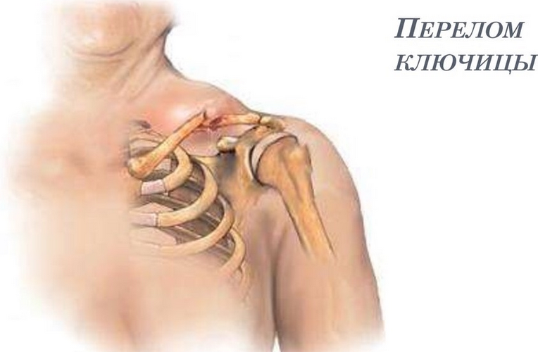 Заживает плечо, ключица после перелома